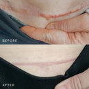 SILICONEFUSION™ C-Section Scar Patch