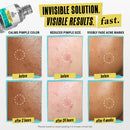 Truly Targeted Acne-Clearing Solution