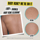 Expertly Clear Acne-Treating & Preventing Lotion