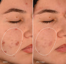 Acne Biotic Moisturizer