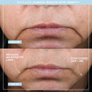 Trinity+ and Effective Lip and Eye Attachment