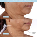 Trinity+ and Effective Lip and Eye Attachment