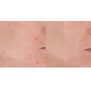 LightStim for Acne