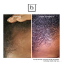 Ultima 12 Hair Growth LaserComb